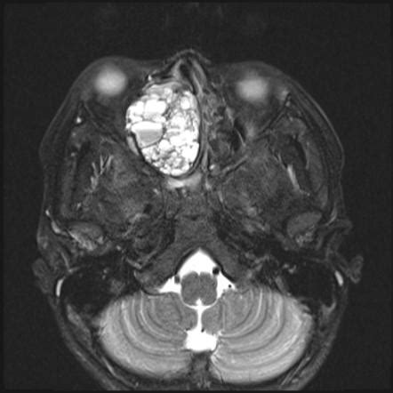 Aneurysmal bone cyst | Radiology Reference Article | Radiopaedia.org