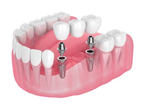 What Do Dental Implants Look Like? A Guide to Natural-Looking Implants