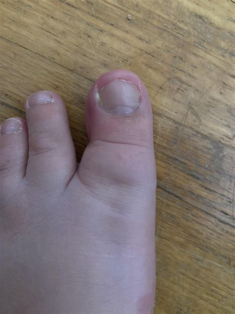 Never had an ingrown toe before but this is so painful now… How do I
