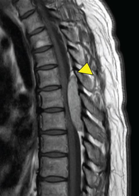 Preoperative Thoracic Mri A Heterogeneous Epidural Posterior Mass