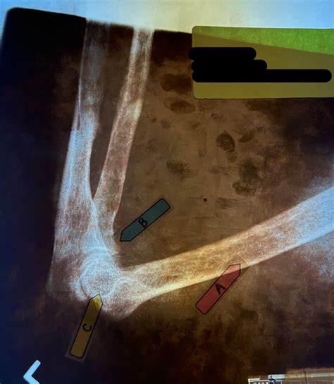 Elbow X Ray Diagram Quizlet