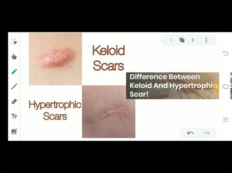 Hypertrophic Scar Vs Keloid