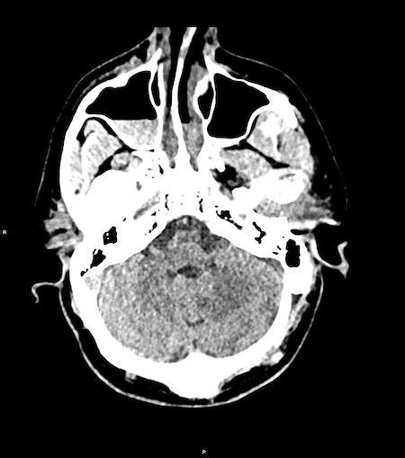 The Radiology Assistant Traumatic Intracranial Hemorrhage