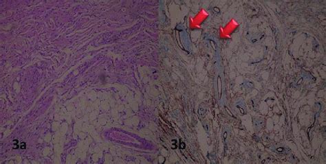 A Encapsulated Tumor Mass Composed Of A Large Number Of Mature