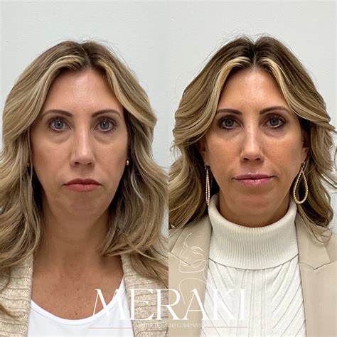 Facial Balancing in Cornelius, NC | Meraki Aesthetics