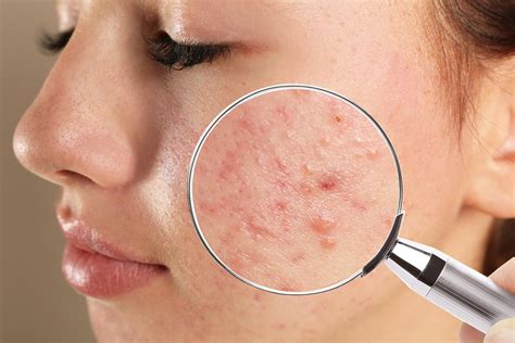 Acne Skin Conditions Skinrx Aesthetic Clinic Pty Ltd