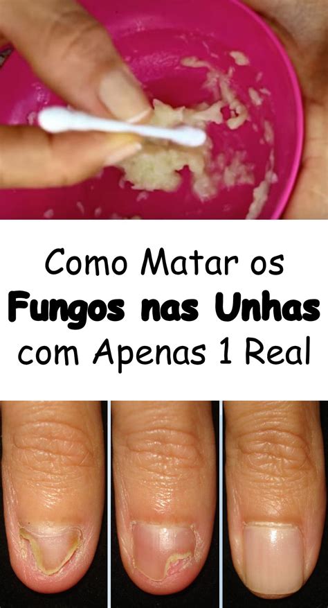 Como Matar Os Fungos Nas Unhas Com Apenas 1 Real Fungos Nas Unhas