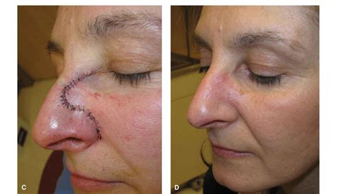 Zygomaticofacial Flap Cpt