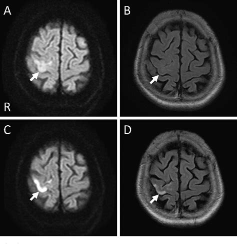 Figure 3 From Carotid Endarterectomy For Mild Carotid Stenosis With