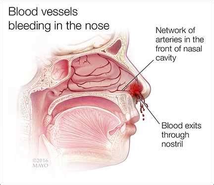 What causes the nose to bleed? 4 easy steps to stop the bleeding ...