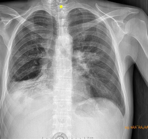 1 Absceso Hepatico Radiografia Torax Derrame Pleural Derecho Ocronos