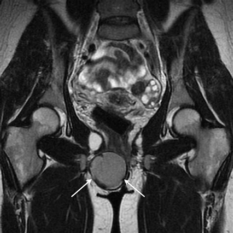Transarterial Embolization Of A Bartholin Cyst Before Resection