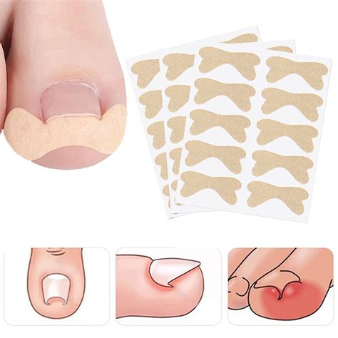 Ingrown Toenail Treatment-ingrown Toenail Corrector Strips-professional
