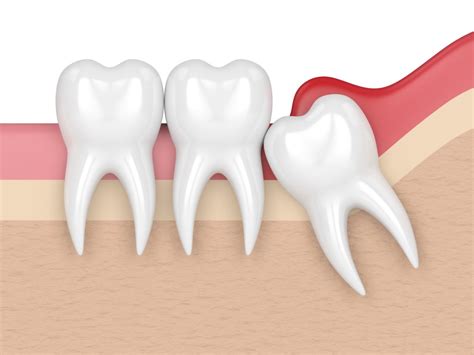 Todo Mundo Tem Dente Siso - Dentes Sisos: Todo mundo precisa Tirar?