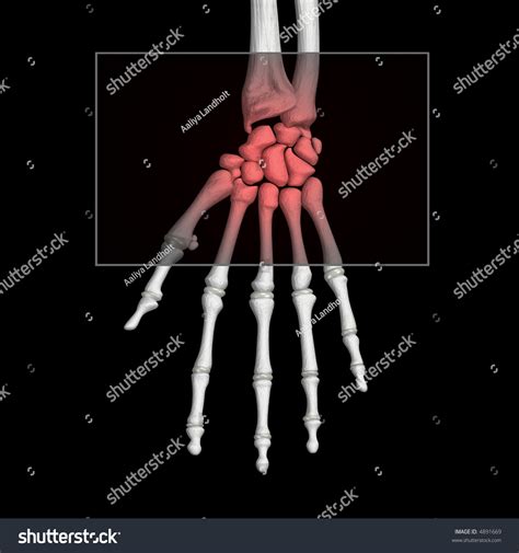 X Ray Of Right Hand Carpel Tunnel Symdrome