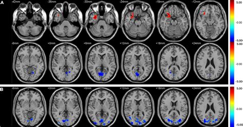 Frontiers Aberrant Brain Spontaneous Activity And Synchronization In