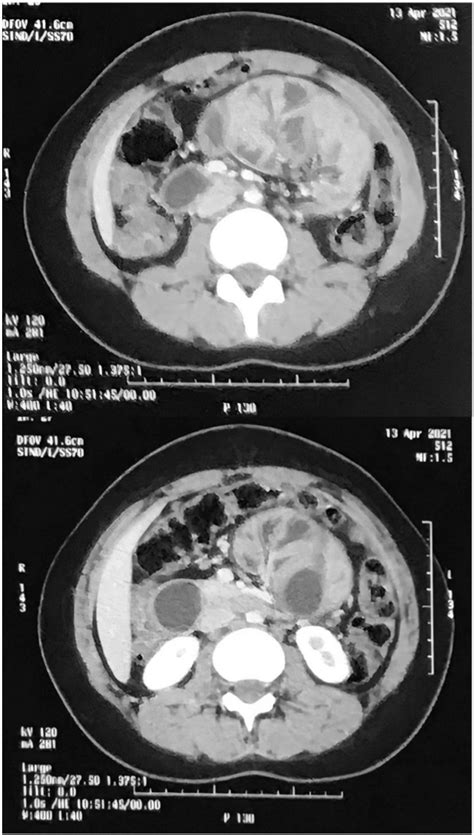 Figure 1 From Abdominal Cocoon Syndrome A Case Report Of A Rare