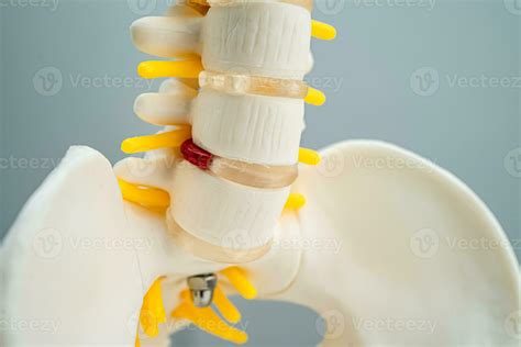 Lumbar Spine Displaced Herniated Disc Fragment Spinal Nerve And Bone