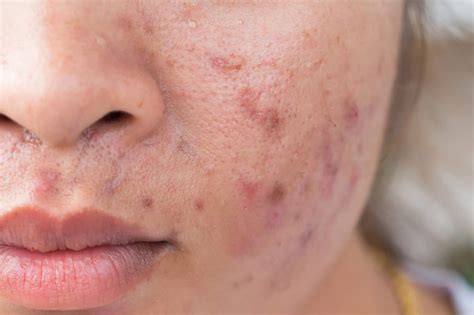 Acne Breakout: What Your Acne Says About You | Reader's Digest