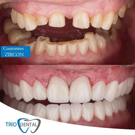 Pr Tesis Dentales Esquel Ticas Albania Trio Dental Center