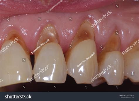 10 Hundred Dental Abrasion Royalty Free Images Stock Photos