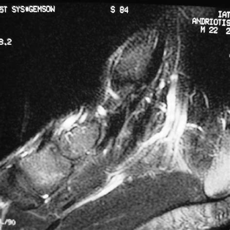 T2-weighted sagittal image demonstrating the dilated, tortuous vein... | Download Scientific Diagram