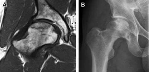 Osteonecrosis Of The Hip Musculoskeletal Key