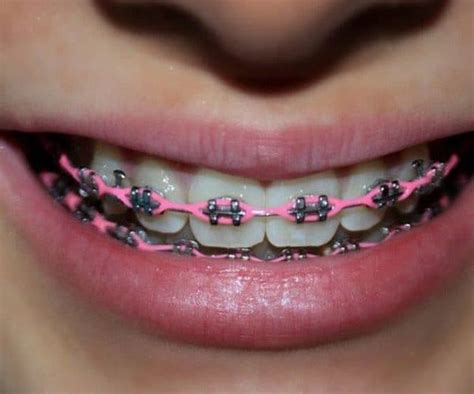 All About Orthodontic Power Chains Archwired