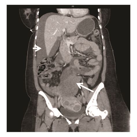 Computed Tomography Of The Abdomen And Pelvis Showing The 8 8 × 7 3 ×