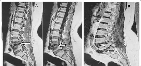 A MRI depicting the discitis involvement around L4-L5, B discitis ...