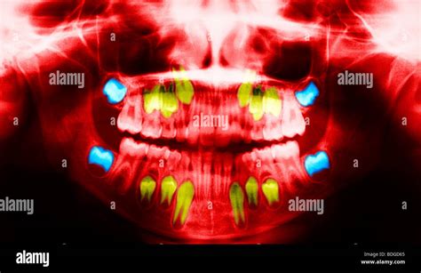 Xray Of Baby Teeth