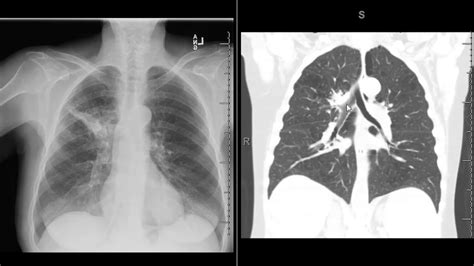 Importance Of Follow Up Chest X Ray To Ensure Resolution Of Presumed