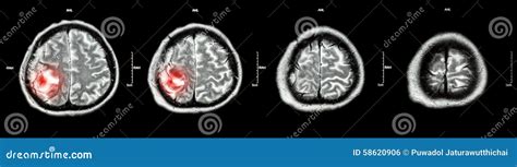 Brain Tumor ( Film CT-scan Of Brain : Show Part Of Brain With Tumor ...