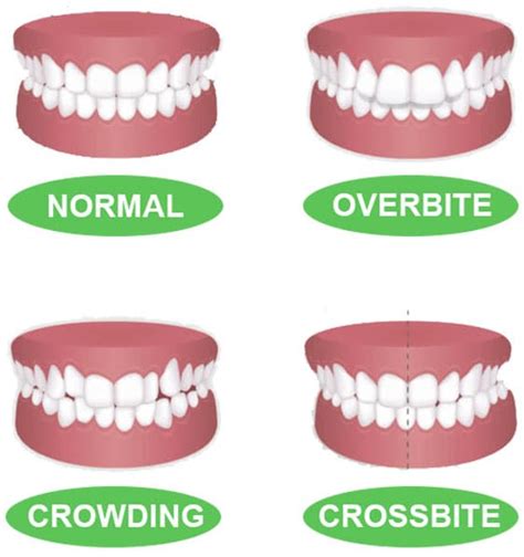 Classification of Teeth | An In-Depth Overview