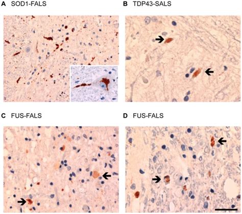 A Cases Of Fals With Sod Mutations Show Extensive Accumulation Of