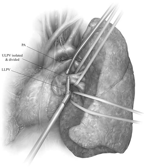 Technique of Video-Assisted Thoracoscopic Left Pneumonectomy ...