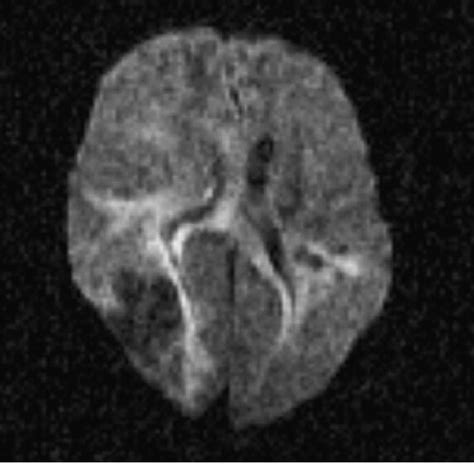 Diffusion Weighted Mri Showing A Right Parietal Hypointense Lesion