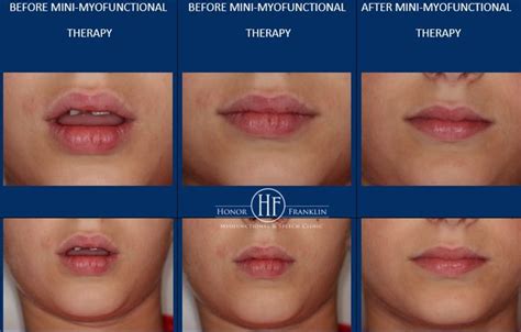 Honor Franklin Myofunctional Speech Clinic Using The Zickefoose Lip