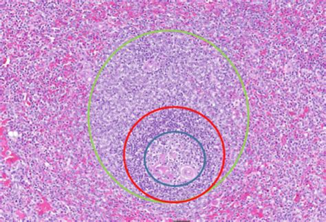 Intro to Lymphoid Neoplasms Flashcards | Quizlet