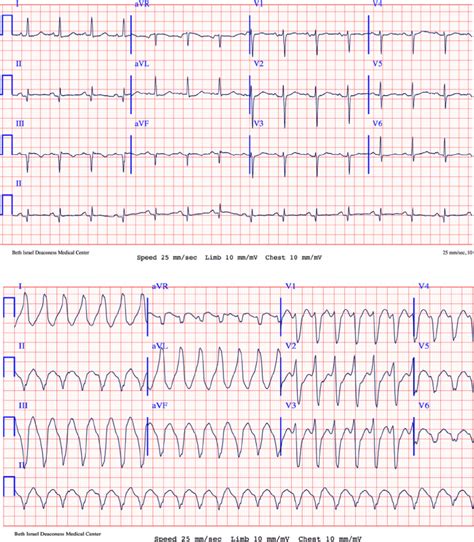 twelve lead electrocardiograms    lead electrocardiogram ecg