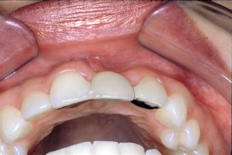 Consequences Of Missing Anterior Teeth