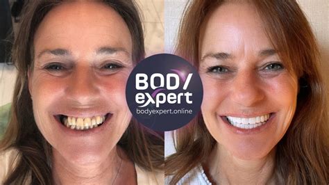 implants dentaires avant apres resultats apres la pose body expert