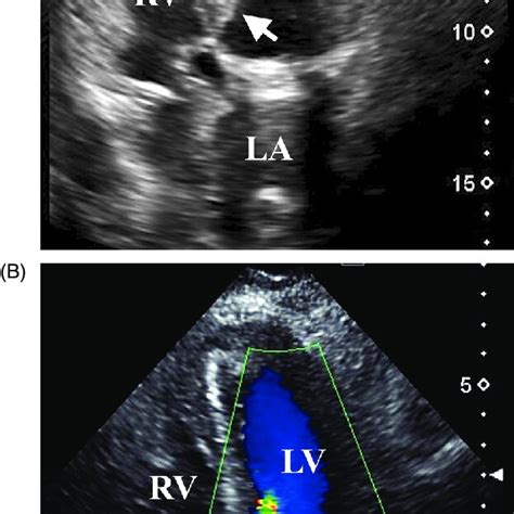 Transthoracic Echocardiograms 1 Year After Sur Gery A The Subaortic