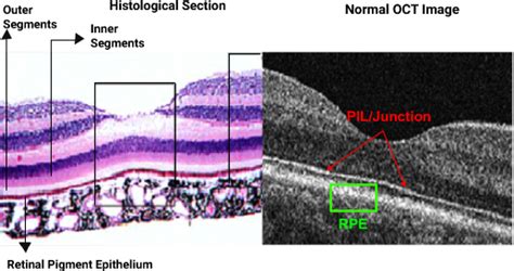 Dots Spots And Other White Retinal Lesions Page 3 Of 61 Retina Revealed