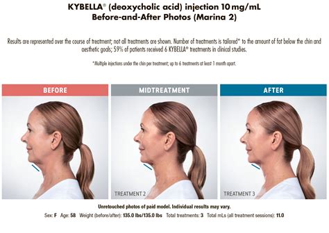 Kybella Double chin treatment - Before & After photos