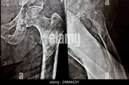 Plain x-ray with high probability of subtrochanteric, trochanteric ...