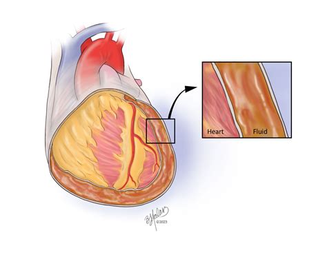 Medical Illustrations Pericarditis Alliance