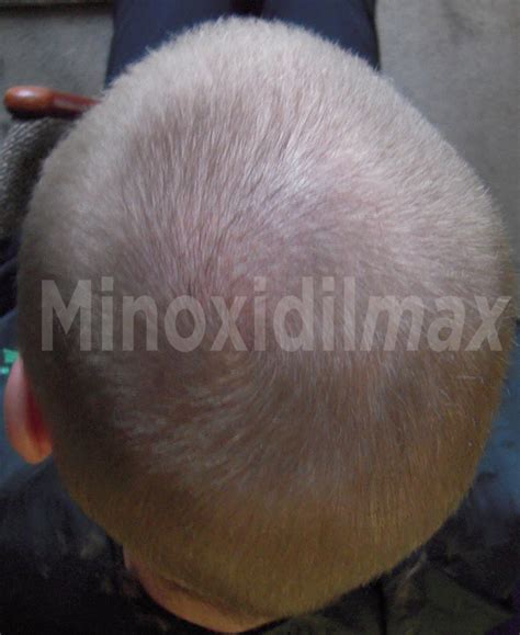 Minoxidil with Finasteride Topical Solution | Dualgen-15 With PG Plus