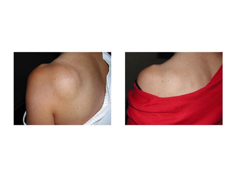 lipoma-lipodissolve-treatment-indianapolis-dr-barry-eppley1 - Explore