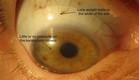 Scleral Lenses Eyetech